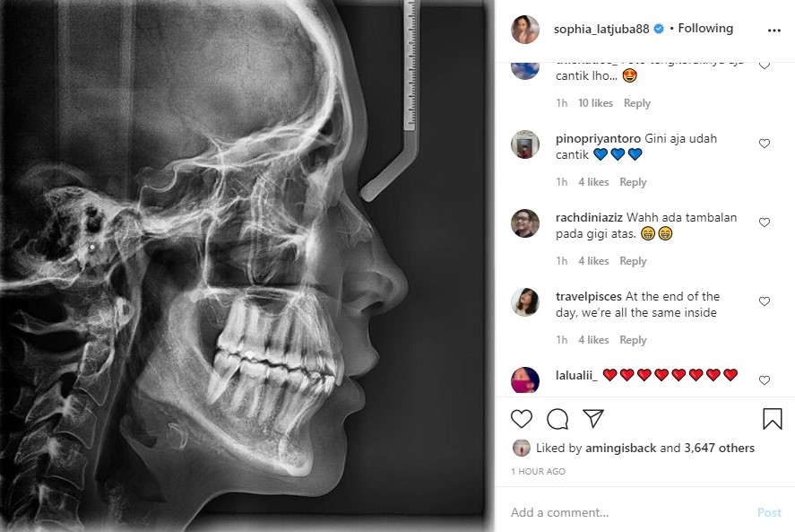 Sophia Latjuba Mendadak Bagikan Foto X-ray Tengkorak, Bagian Gigi Curi Perhatian
