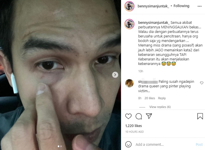 Bekas Luka di Tubuh Jonathan Frizzy Kembali Terungkap