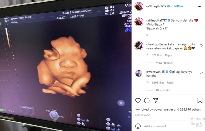 Bayi Nagita Slavina dan Raffi Ahmad Senyum-senyum Saat USG Bikin Gemes, Sempat Buka Mata?