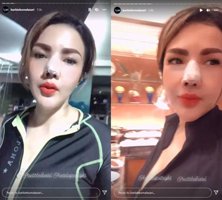 Begini Potret Terbaru Barbie Kumalasari Usai Korbankan Tulang Telinganya Untuk Operasi Hidung