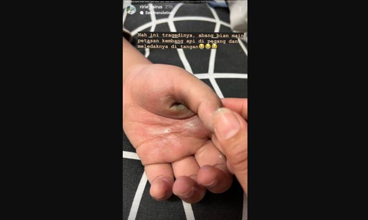 Putra Ayus dan Ririe Fairus Alami Luka Bakar di Tangan Gegara Petasan, Begini Kondisinya Terbaru