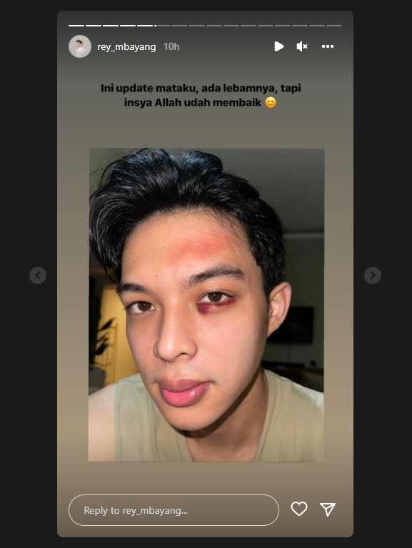 Buka Perban, Begini Kondisi Mata Rey Mbayang yang Tampak Lebam
