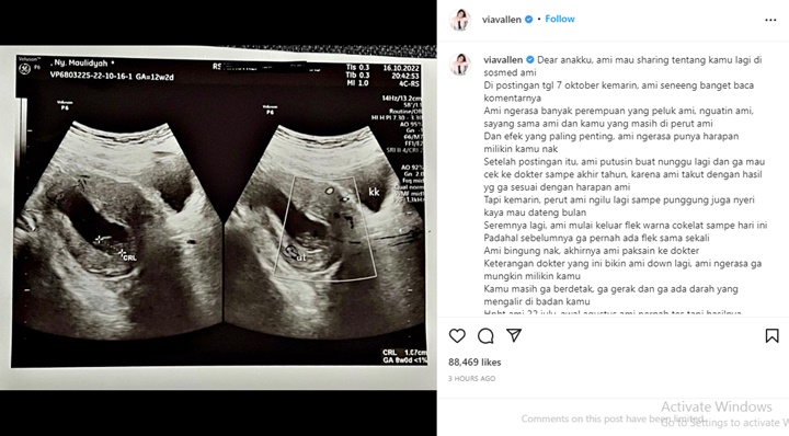 Via Vallen Kesakitan Masih Pertahankan Janin yang Dikandung: Ami Bingung Nak