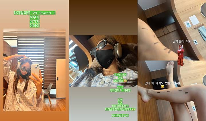 Kwon Yuri SNSD menceritakan jika operasi varises