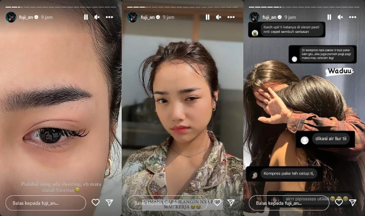 Fuji An Panik Matanya Mendadak Bintitan, Malah Dapat Saran Nyeleneh Untuk Obati