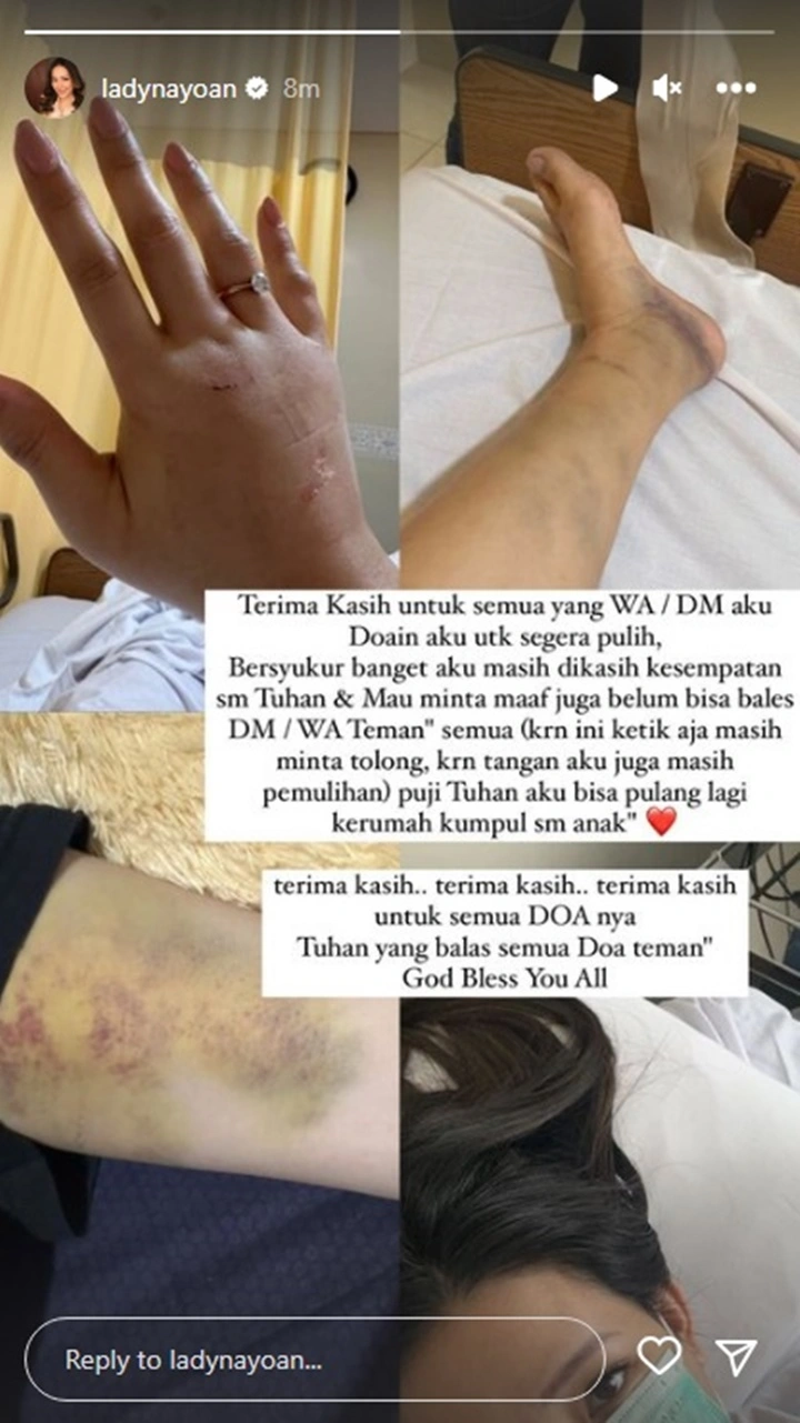 Lady Nayoan Akhirnya Rilis Foto Bagian Tubuhnya yang Memar dan Bengkak Usai Kecelakaan