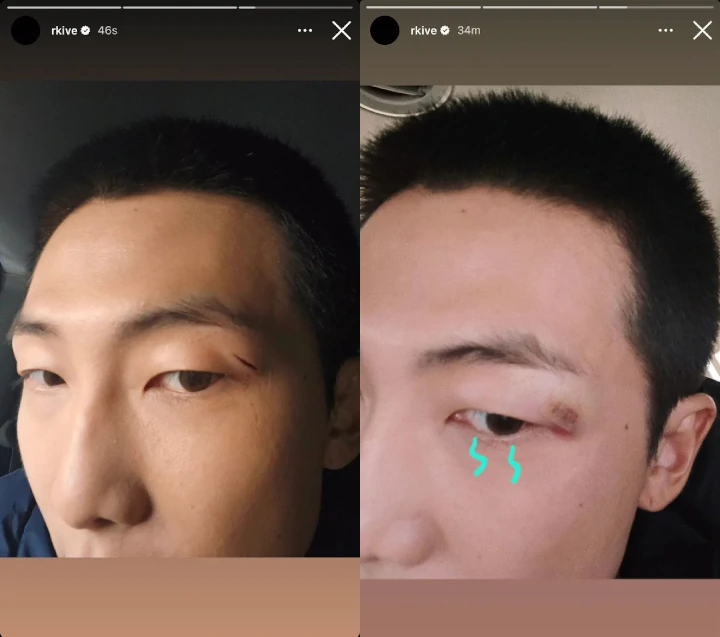 Cedera Kelopak Mata RM BTS Ternyata Lebih Serius dari yang Kelihatan