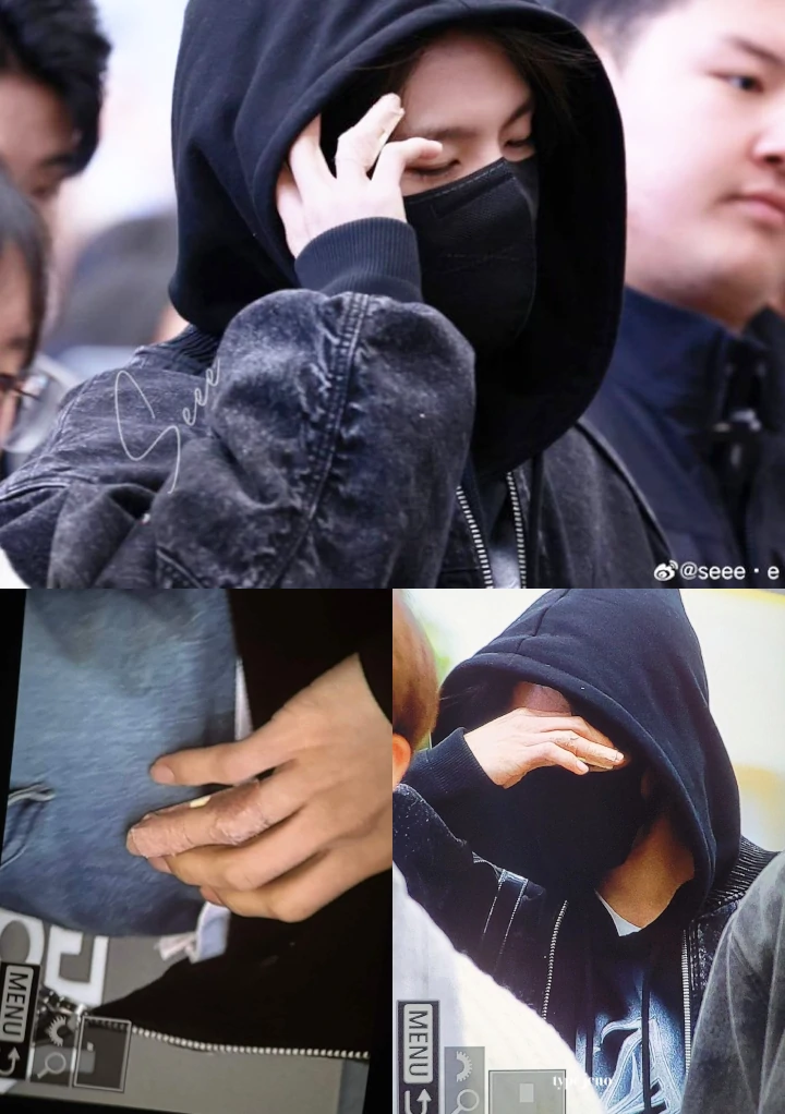jari tangan Jeno NCT cedera