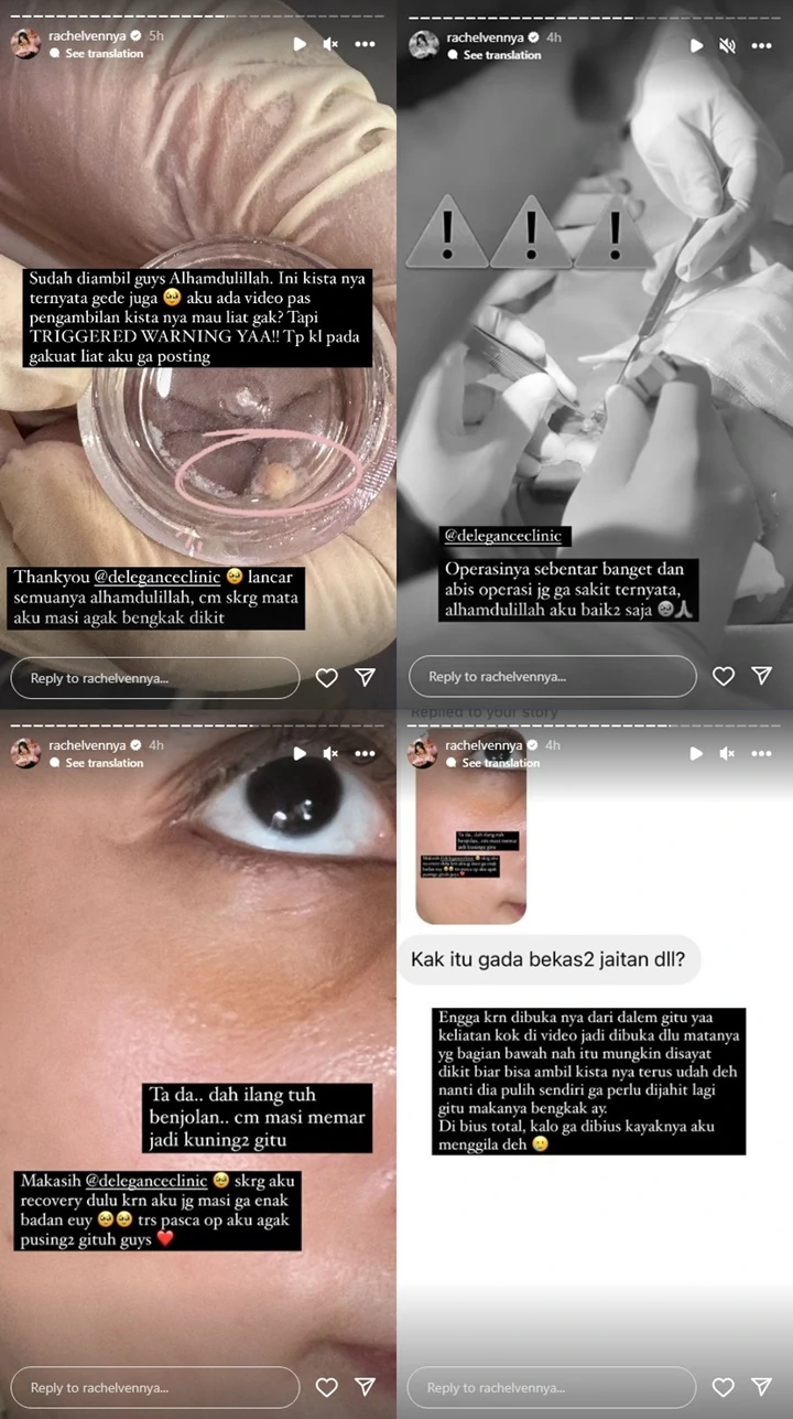 Rachel Vennya Bagikan Kondisi Terkini Usai Jalani Operasi Pengangkatan Kista