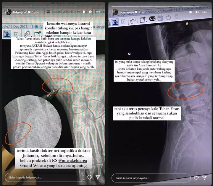 Lady Nayoan Bagikan Cerita Tak Terduga Terkait Patah Tulang di Kakinya
