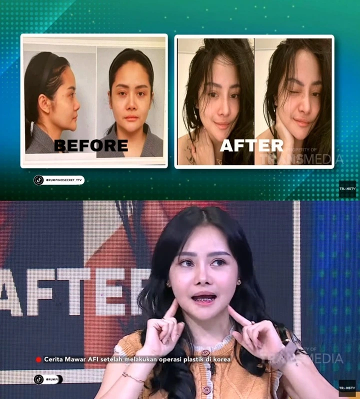 Mawar AFI Sempat Jadi Korban Malpraktik Sebelum Lakukan Oplas