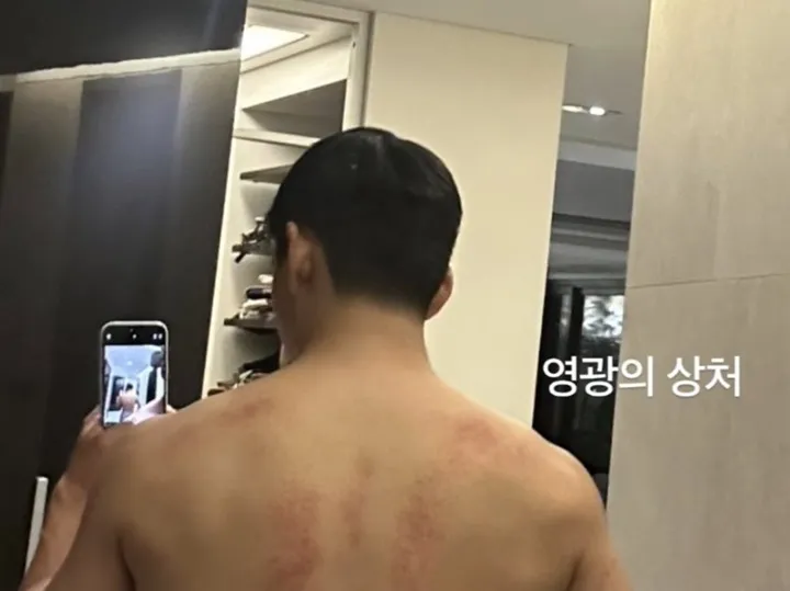V BTS Picu Kontroversi soal Casing HP kala Pamer Luka Memar di Punggung