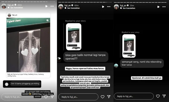 Fuji An Sambat Soal Penyakit Skoliosis