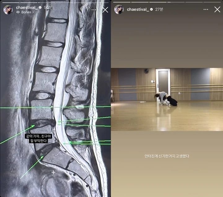 Lee Chaeyeon Bikin Ngilu usai Pamer Hasil Rontgen Tulang Punggung yang Cedera