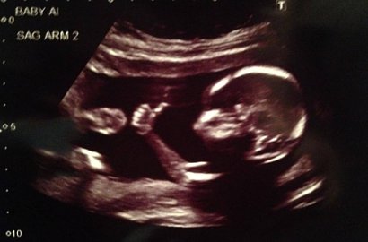 Foto USG Bayi Beri Salam Jempol dari dalam Kandungan