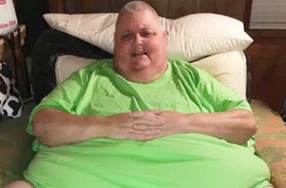 Diduga Lemak, Pria Ini Justru Idap Tumor 57 Kilogram di Perut