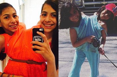 Kembar Siam 16 Tahun, Remaja Cantik Ini Menolak Dipisahkan
