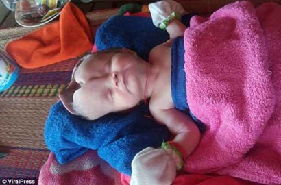 Bayi Ini Kehilangan Separuh Tengkorak, Orangtua Sedih Tak Bisa Biayai Operasi Hingga Minta Sumbangan