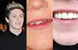 Niall Horan 1D Pamer Gigi Sempurna Setelah Pakai Kawat Gigi