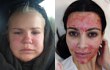 Wajah Artis Ini Bengkak Gara-Gara Tiru Facial Darah Kim Kardashian