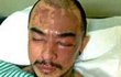 Foto Wajah Barry 'Saint Loco' Usai Disiram Air Keras